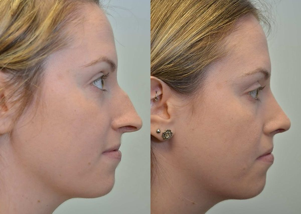 Rhinoplasty Before & After Gallery - Patient 254607 - Image 2