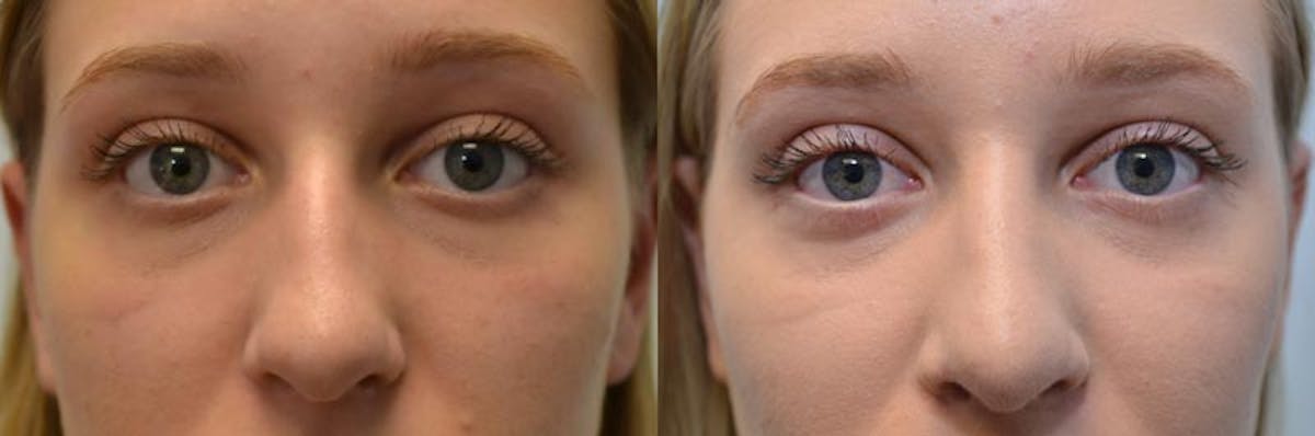 Rhinoplasty Before & After Gallery - Patient 135222 - Image 1