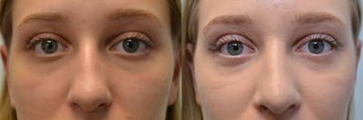 Rhinoplasty Before & After Gallery - Patient 135222 - Image 1