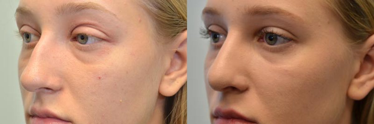 Rhinoplasty Before & After Gallery - Patient 135222 - Image 2
