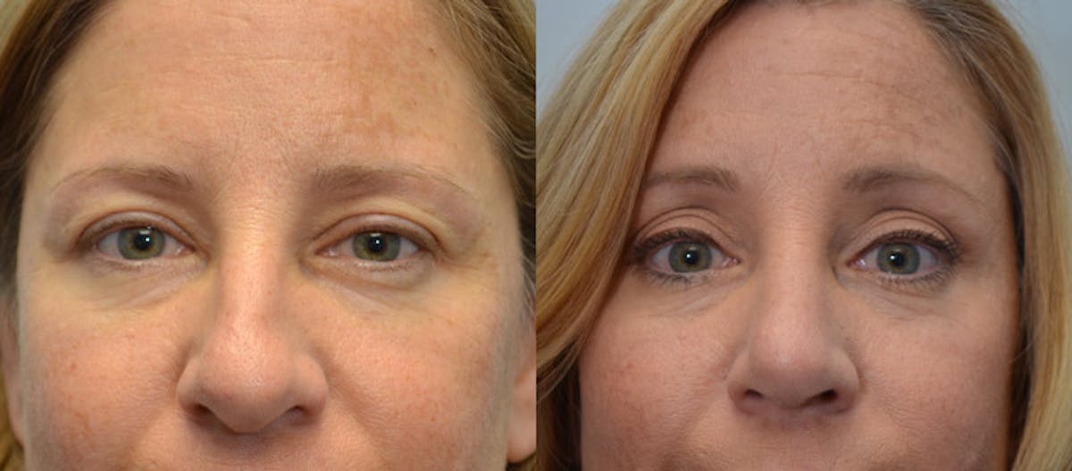 Rhinoplasty Before & After Gallery - Patient 309342 - Image 1