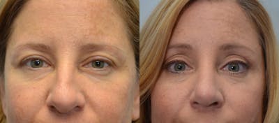 Rhinoplasty Before & After Gallery - Patient 309342 - Image 1