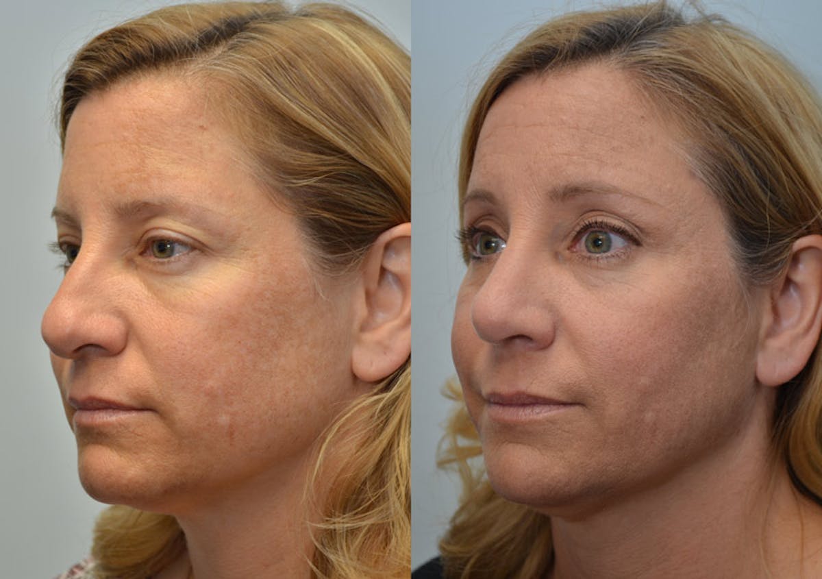 Rhinoplasty Before & After Gallery - Patient 309342 - Image 3