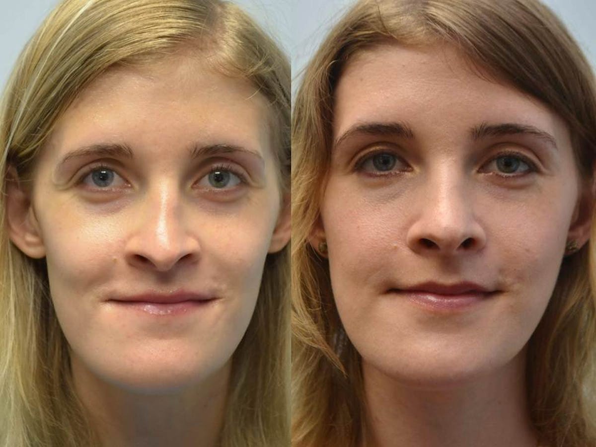 Rhinoplasty (Nose Reshaping Before & After Gallery - Patient 396537 - Image 1
