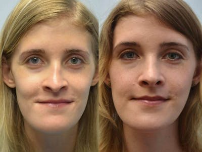 Rhinoplasty Before & After Gallery - Patient 194333 - Image 1