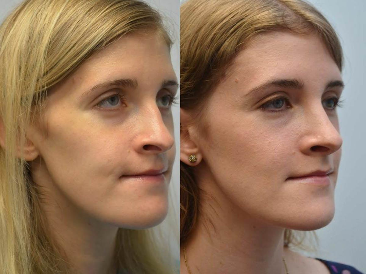 Rhinoplasty (Nose Reshaping Before & After Gallery - Patient 396537 - Image 2