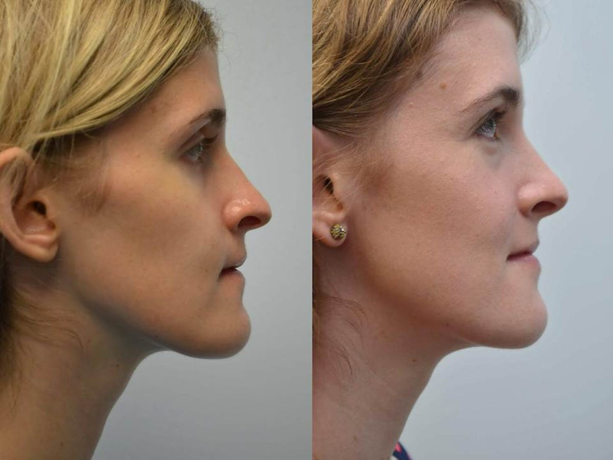 Rhinoplasty (Nose Reshaping Before & After Gallery - Patient 396537 - Image 3