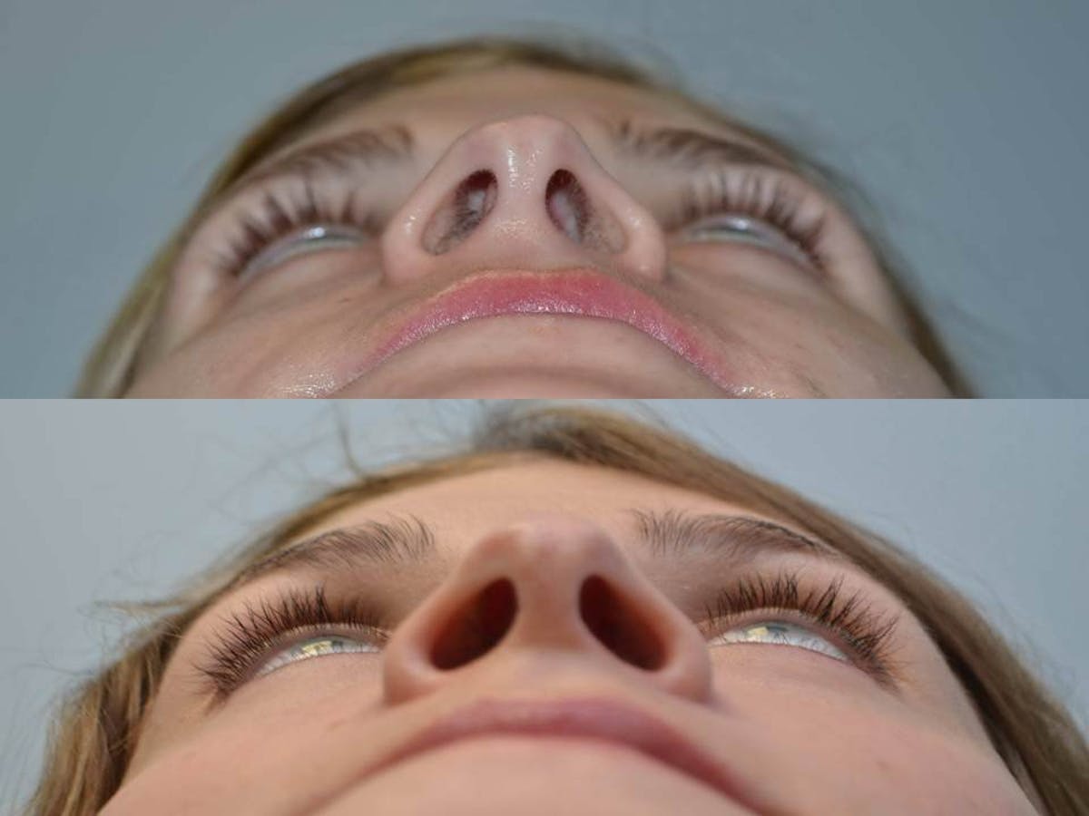 Rhinoplasty (Nose Reshaping Before & After Gallery - Patient 396537 - Image 4
