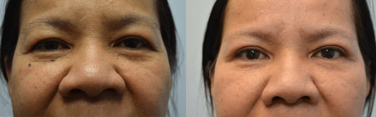 Rhinoplasty Before & After Gallery - Patient 414747 - Image 1