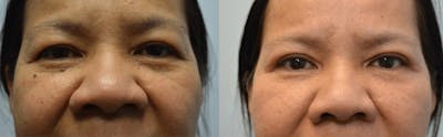 Rhinoplasty Before & After Gallery - Patient 414747 - Image 1