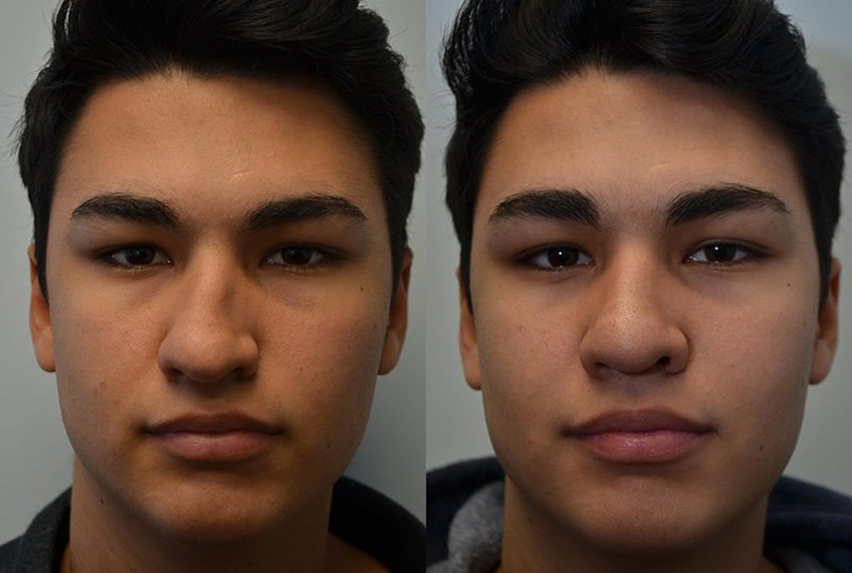 Rhinoplasty Before & After Gallery - Patient 226384 - Image 1