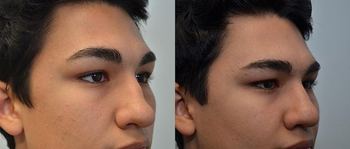 Rhinoplasty Before & After Gallery - Patient 226384 - Image 2