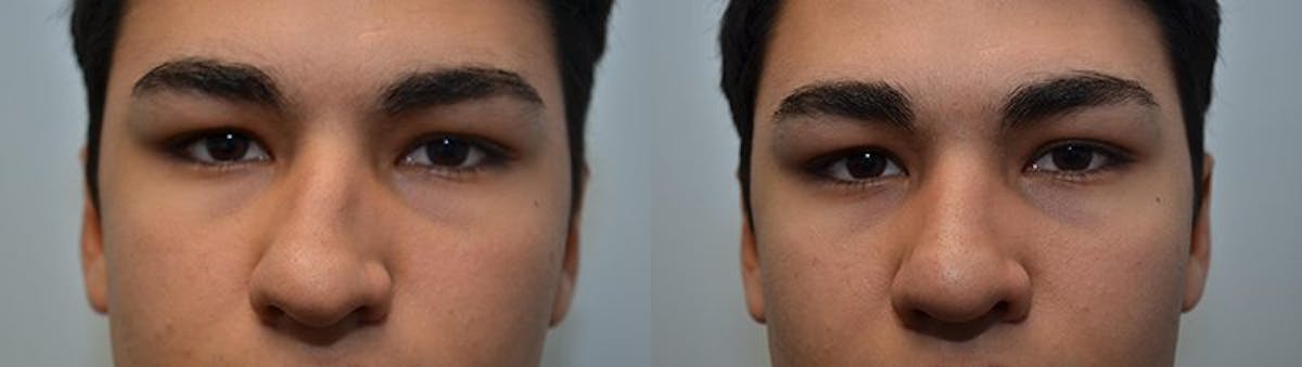 Rhinoplasty Before & After Gallery - Patient 226384 - Image 3