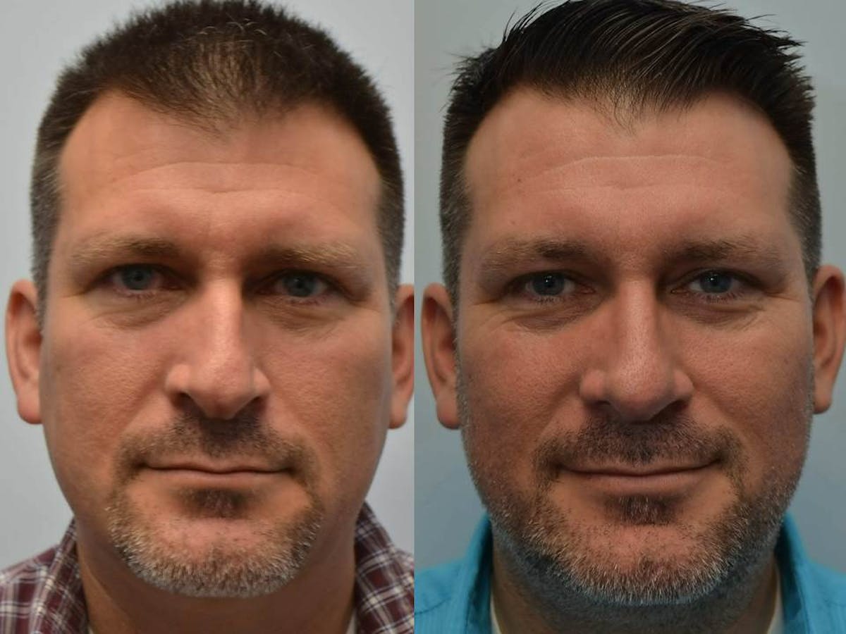 Rhinoplasty Before & After Gallery - Patient 404172 - Image 1