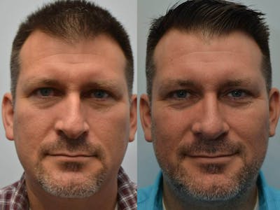 Rhinoplasty Before & After Gallery - Patient 404172 - Image 1