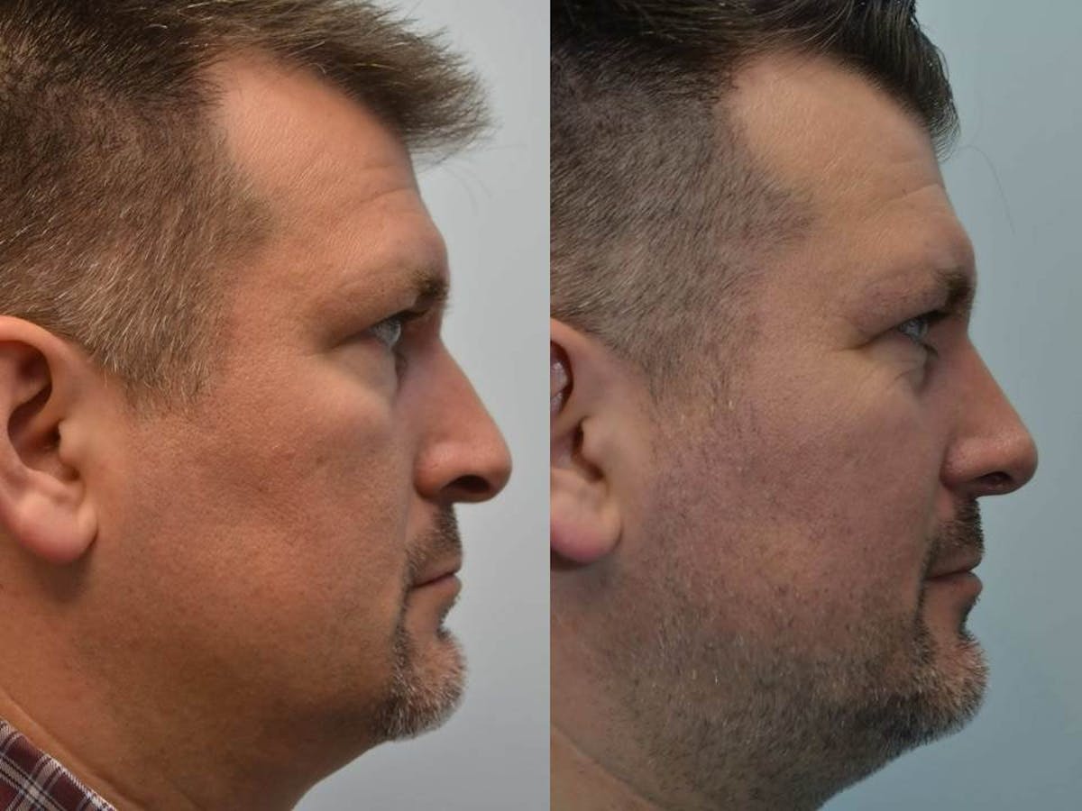 Rhinoplasty Before & After Gallery - Patient 404172 - Image 3