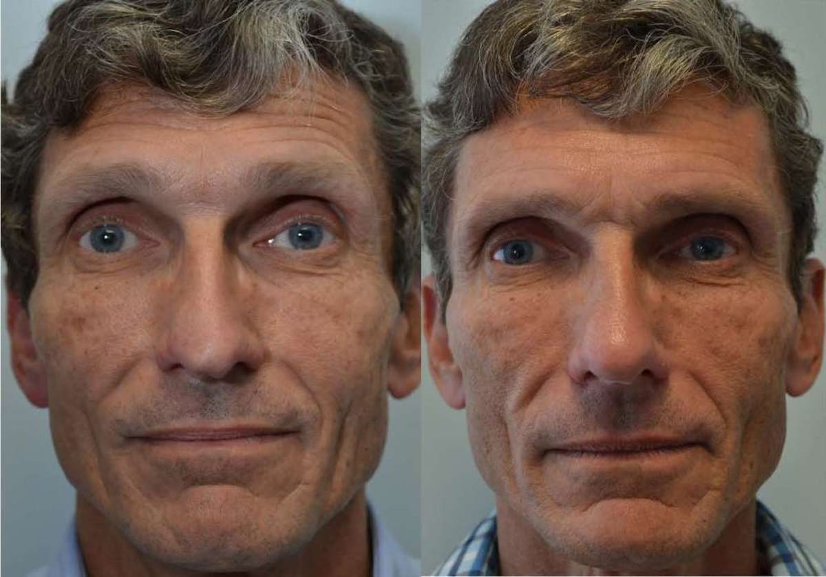 Rhinoplasty Before & After Gallery - Patient 121308 - Image 1