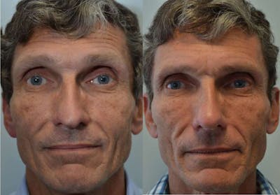 Rhinoplasty Before & After Gallery - Patient 121308 - Image 1