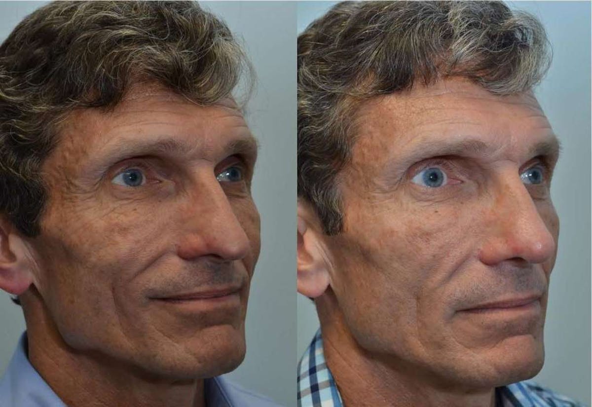 Rhinoplasty Before & After Gallery - Patient 121308 - Image 2