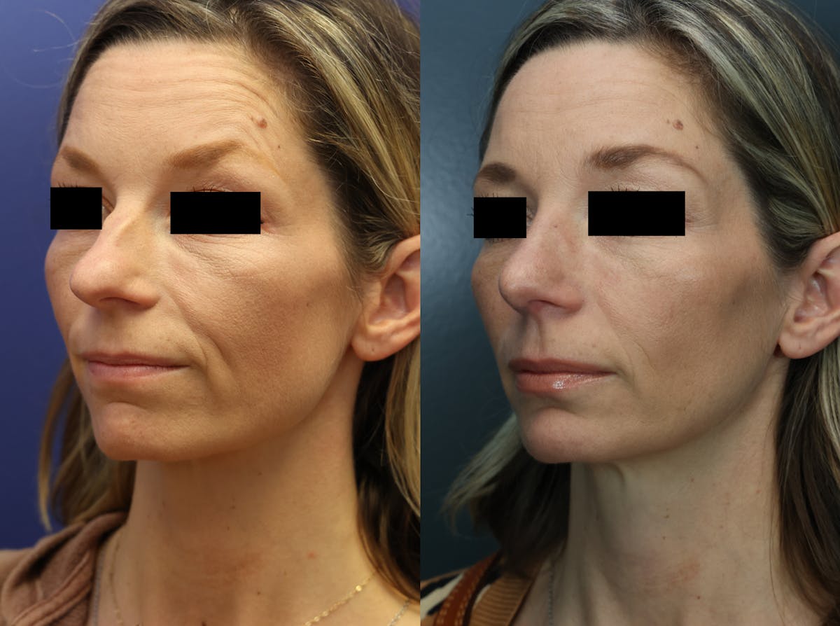 Rhinoplasty Before & After Gallery - Patient 223002 - Image 1