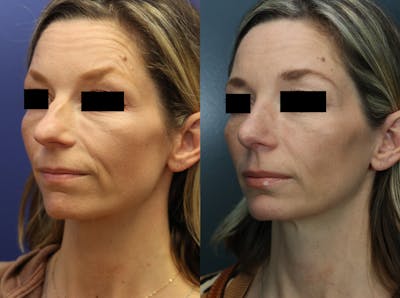 Rhinoplasty Before & After Gallery - Patient 223002 - Image 1