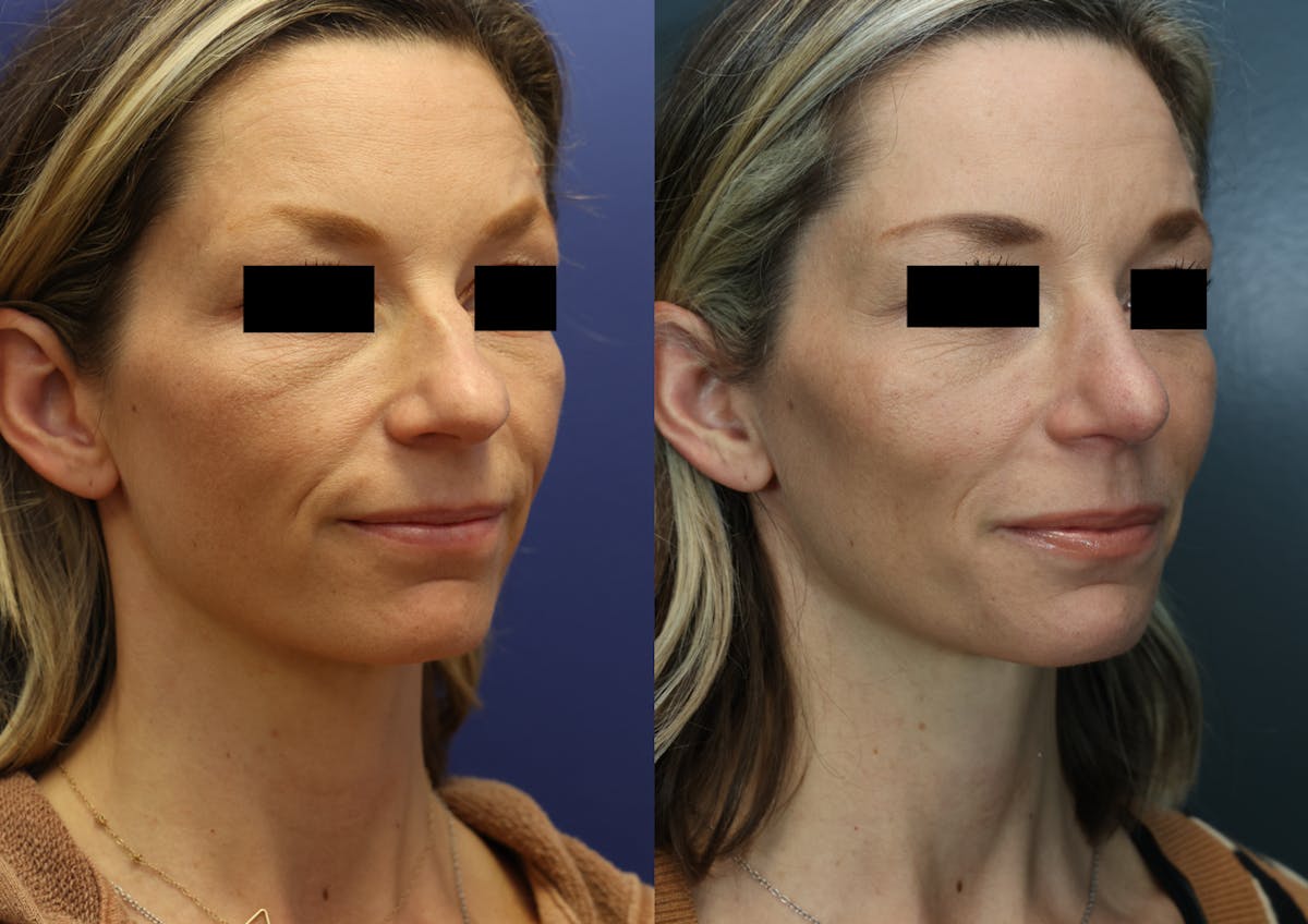 Rhinoplasty Before & After Gallery - Patient 223002 - Image 2