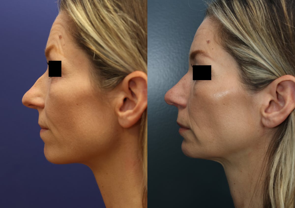 Rhinoplasty Before & After Gallery - Patient 223002 - Image 3