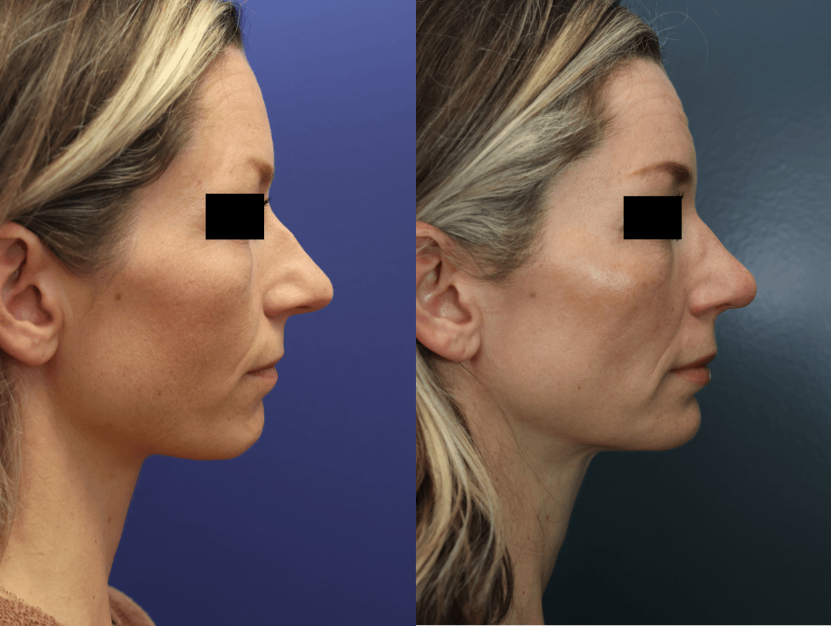 Rhinoplasty Before & After Gallery - Patient 223002 - Image 4