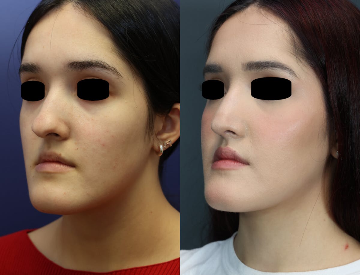Rhinoplasty Before & After Gallery - Patient 198417 - Image 1