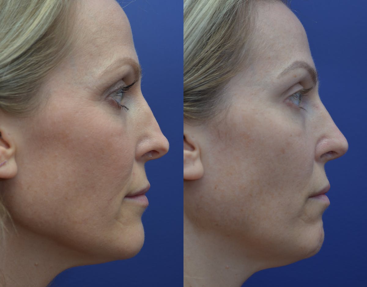 Rhinoplasty Before & After Gallery - Patient 371451 - Image 1