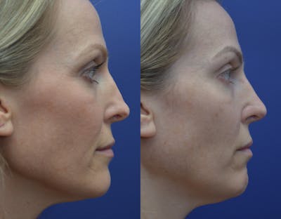 Rhinoplasty Before & After Gallery - Patient 371451 - Image 1