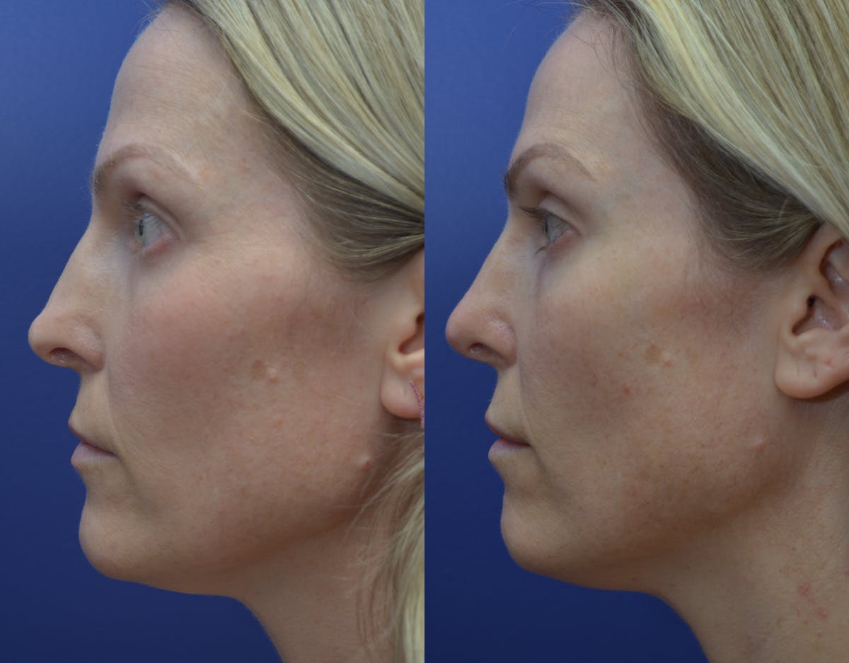 Rhinoplasty Before & After Gallery - Patient 371451 - Image 2
