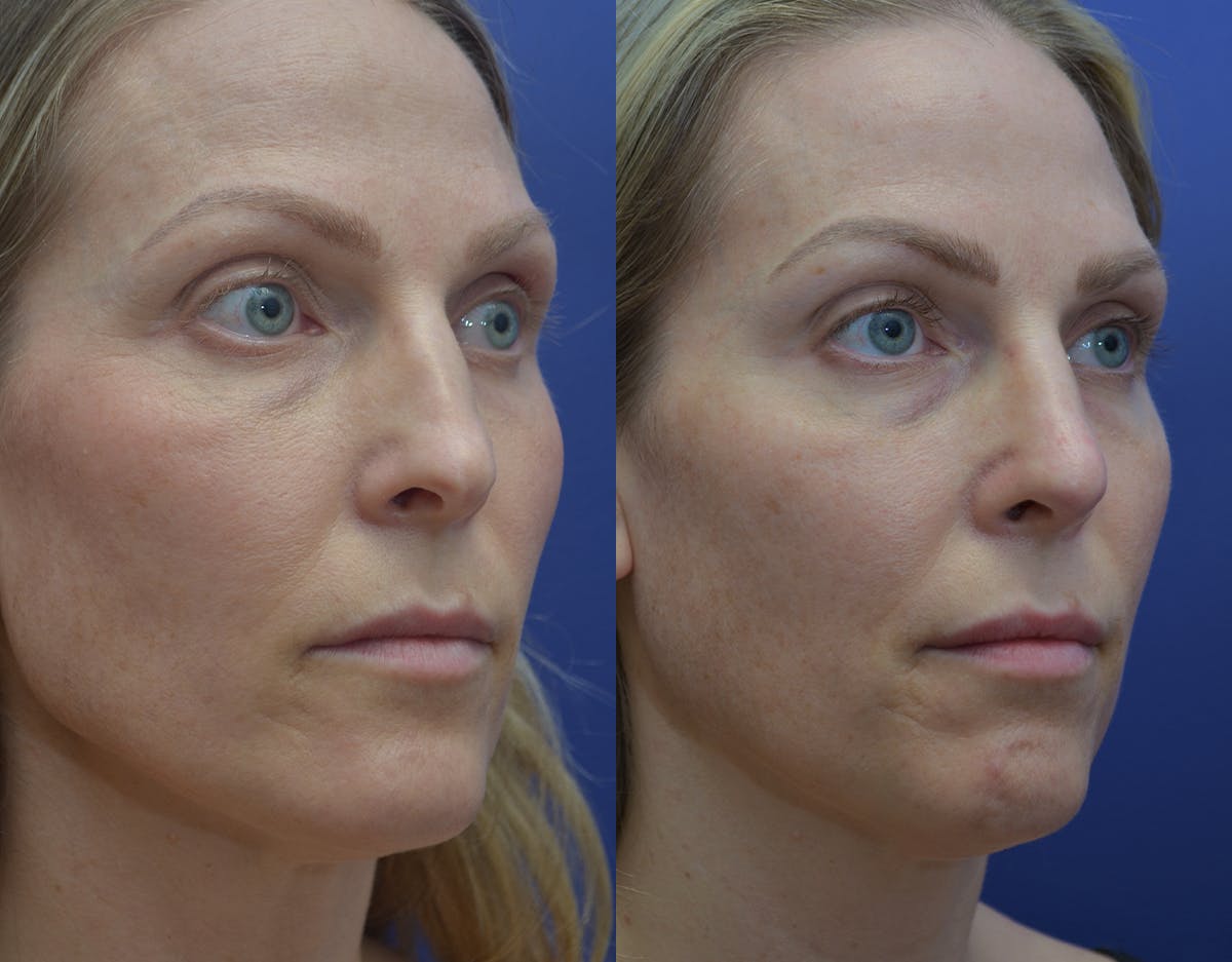 Rhinoplasty Before & After Gallery - Patient 371451 - Image 3
