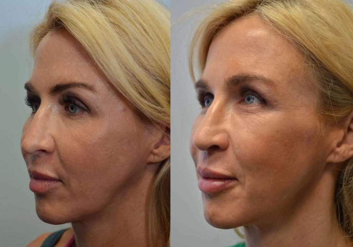 Rhinoplasty Before & After Gallery - Patient 417857 - Image 1