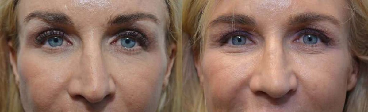 Rhinoplasty Before & After Gallery - Patient 417857 - Image 2