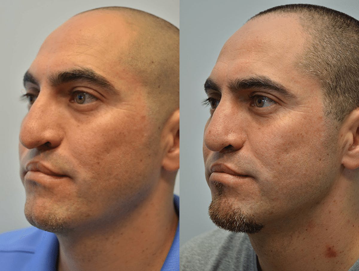 Revision Rhinoplasty Before & After Gallery - Patient 227831 - Image 1