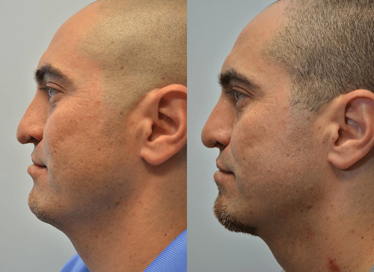 Revision Rhinoplasty Before & After Gallery - Patient 227831 - Image 2