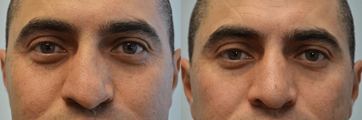 Revision Rhinoplasty Before & After Gallery - Patient 227831 - Image 3