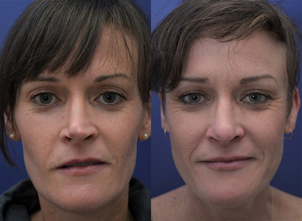 Revision Rhinoplasty Before & After Gallery - Patient 301916 - Image 1