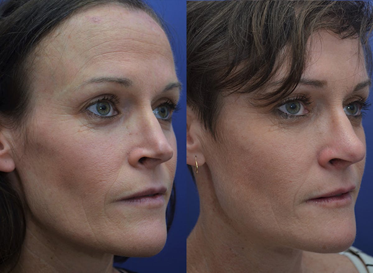 Revision Rhinoplasty Before & After Gallery - Patient 301916 - Image 2