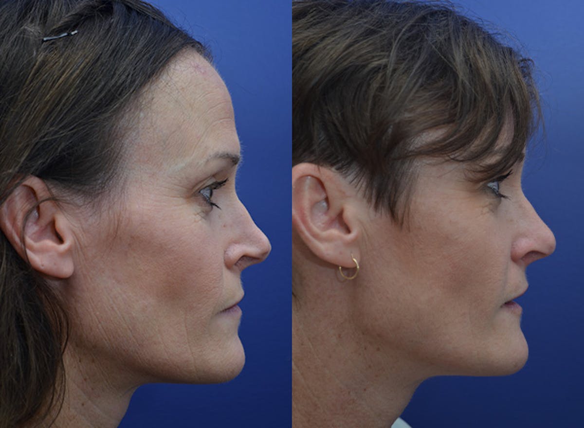 Revision Rhinoplasty Before & After Gallery - Patient 301916 - Image 3