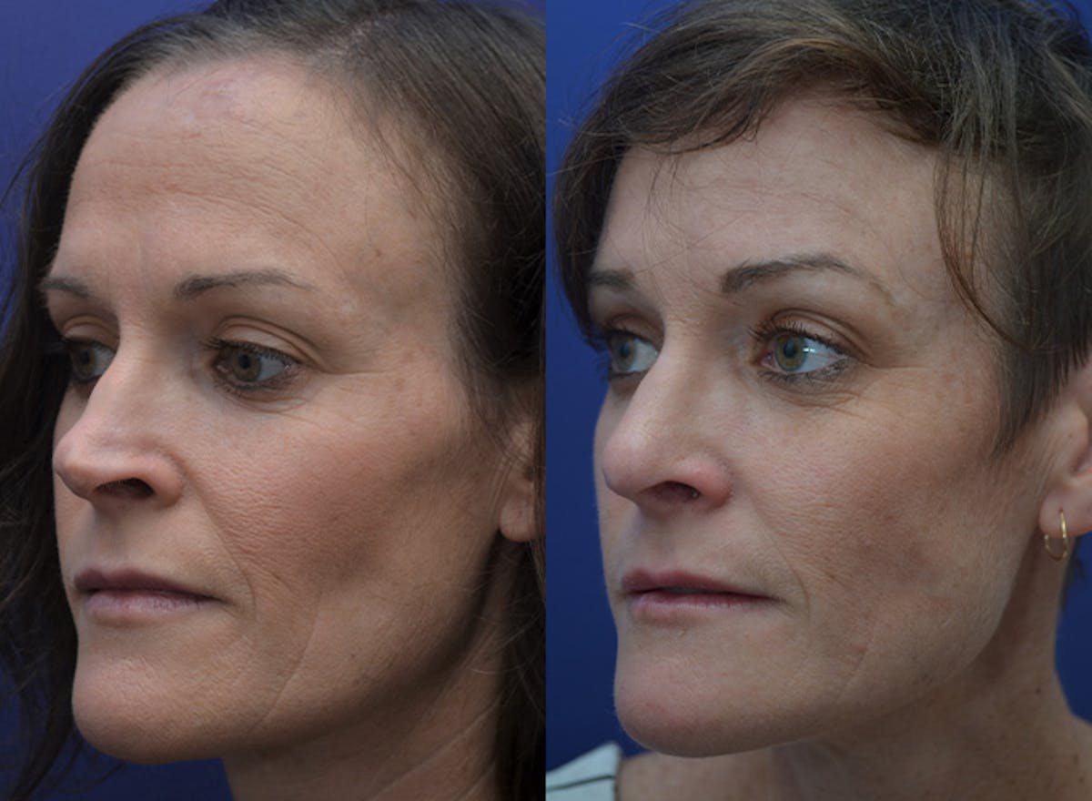 Revision Rhinoplasty Before & After Gallery - Patient 301916 - Image 4