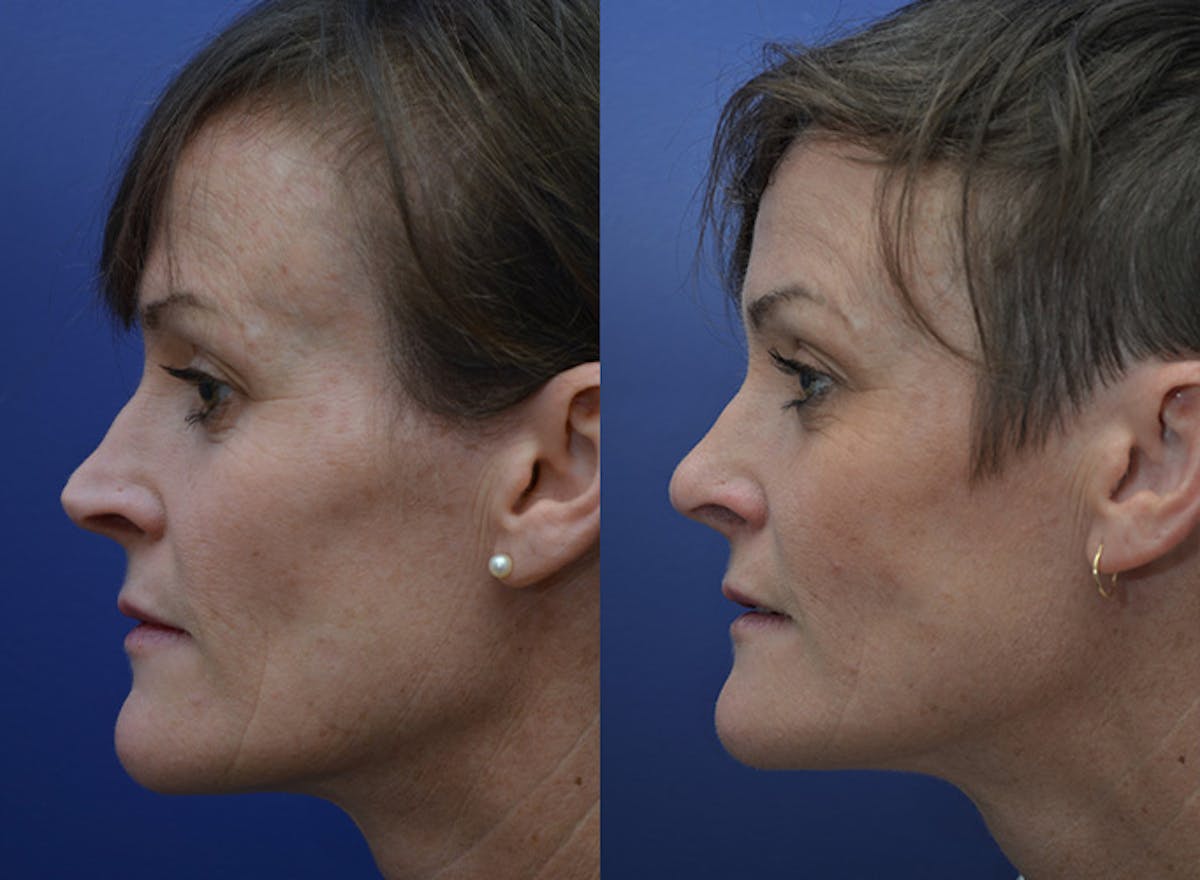 Revision Rhinoplasty Before & After Gallery - Patient 301916 - Image 5