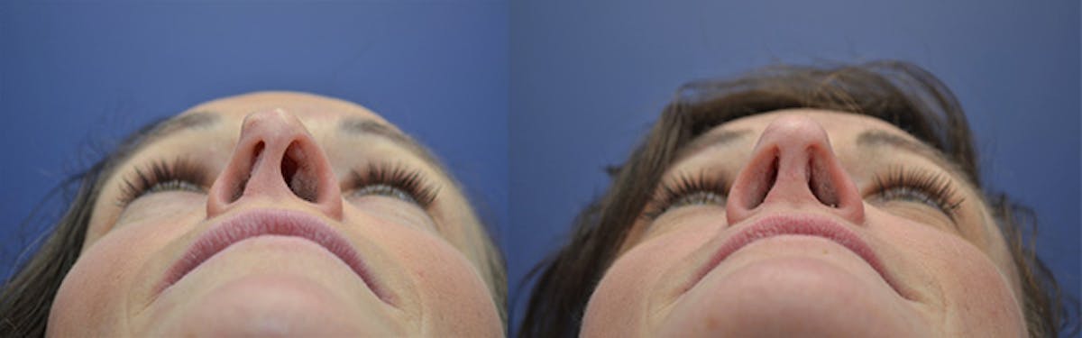 Revision Rhinoplasty Before & After Gallery - Patient 301916 - Image 6