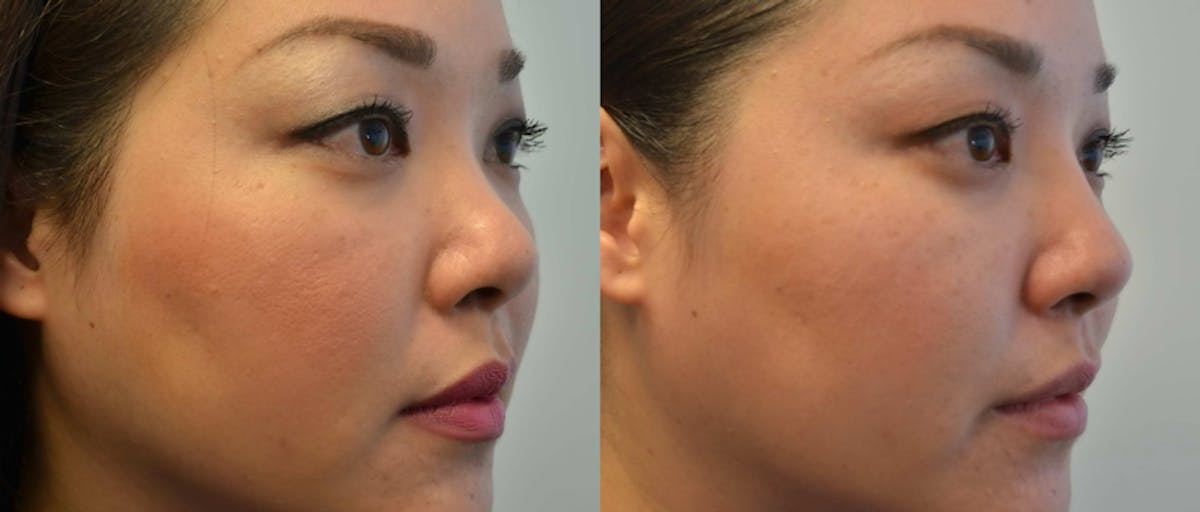 Non-Surgical Rhinoplasty Before & After Gallery - Patient 310853 - Image 1