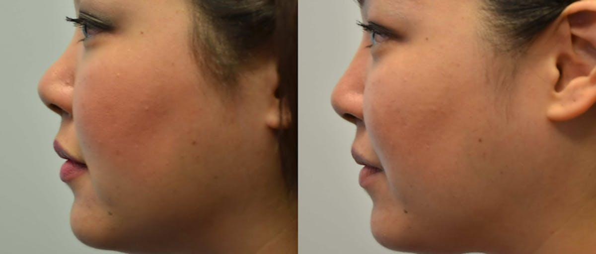 Non-Surgical Rhinoplasty Before & After Gallery - Patient 310853 - Image 2
