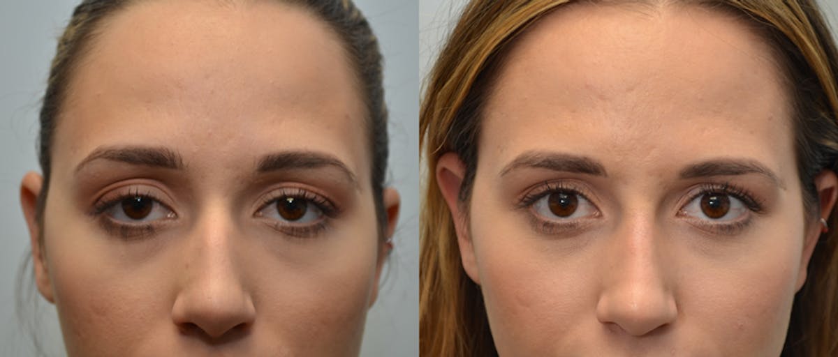 Non-Surgical Rhinoplasty Before & After Gallery - Patient 336367 - Image 1