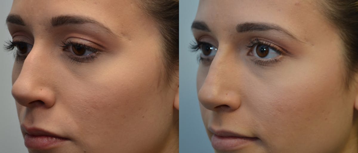 Non-Surgical Rhinoplasty Before & After Gallery - Patient 336367 - Image 2
