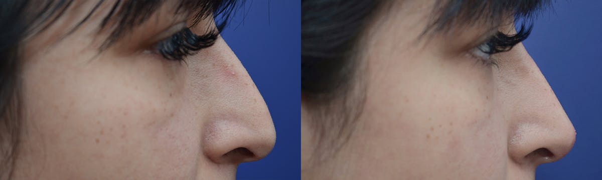Non-Surgical Rhinoplasty Before & After Gallery - Patient 227742 - Image 1