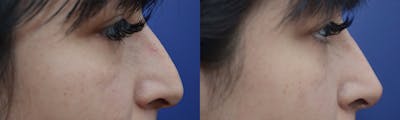 Non-Surgical Rhinoplasty Before & After Gallery - Patient 227742 - Image 1